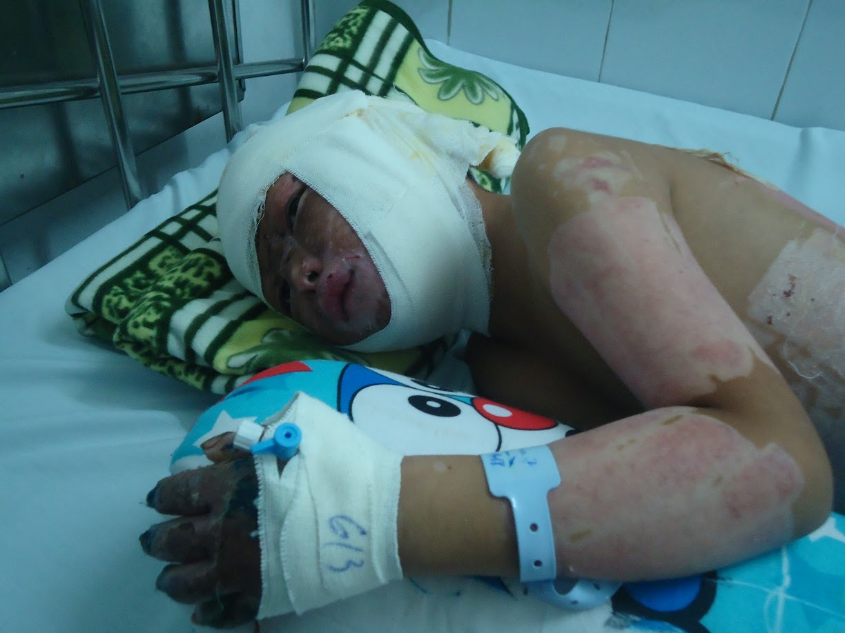 Con gái bỏng ga nguy kịch, cha mẹ nghèo cầu cứu