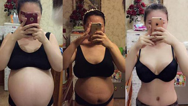 Cắt phăng 2 tảng mỡ bụng để giảm cân có nguy hiểm?