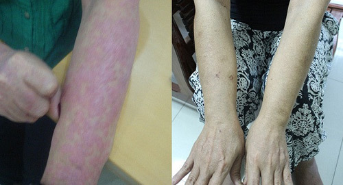 Thoát bệnh vảy nến nhờ Đông y