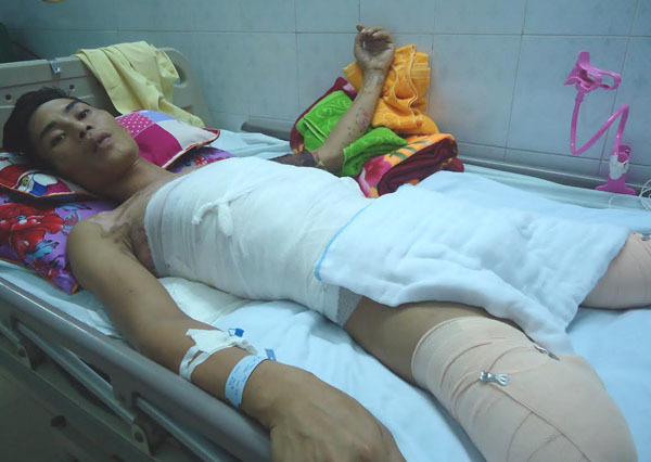 Bỏng điện cao thế, người bố nghèo của 4 đứa con nguy kịch tính mạng