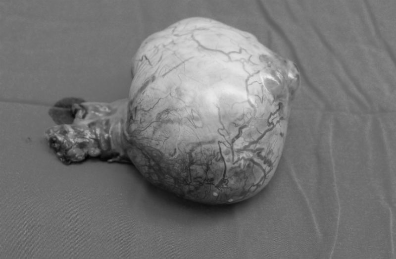 Khám đau bụng, phát hiện ung thư tinh hoàn trong ổ bụng