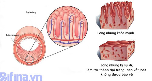 Kinh nghiệm hay đối phó với viêm đại tràng của người Nhật