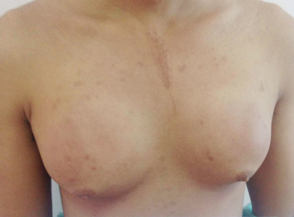 Chàng trai bơm silicon để ngực to như phụ nữ