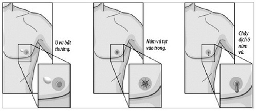 Các dấu hiệu báo động ung thư vú ở nam giới