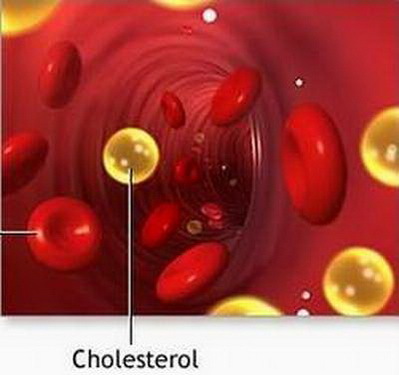 Cách ngăn ngừa và trị rối loạn lipid máu