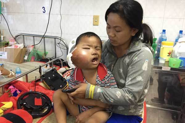 Nghẹn lòng cậu bé ung thư bị biến dạng khuôn mặt