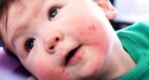 Những lưu ý khi trẻ bị tay chân miệng