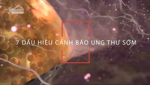 7 dấu hiệu tưởng vô hại nhưng cảnh báo ung thư nguy hiểm