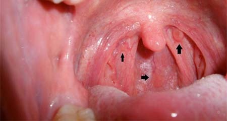 Ung thư vòm họng phát triển rất nhanh: Thấy có dấu hiệu sau thì khám ngay để ngăn ngừa