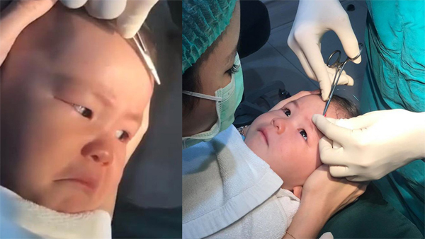 Em bé không khóc khi bị khâu sống vết thương gây bão mạng