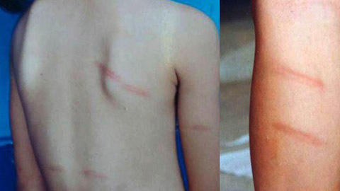 Cô giáo đánh học sinh  lớp 1 thâm tím chân và lưng