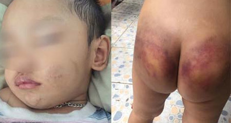 Người mẹ trẻ tiếp tay cho chồng hờ, bạo hành con trai 2 tuổi phải nhập viện cấp cứu?