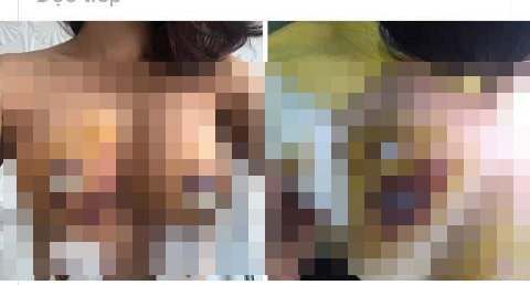 Bộ Y tế lên tiếng vụ cô gái có dấu hiệu hoại tử sau nâng ngực