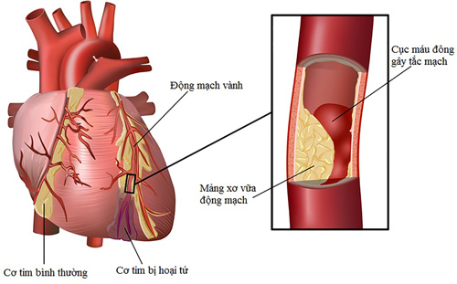 Đang khỏe mạnh sao vẫn mắc tiểu đường, mỡ máu?