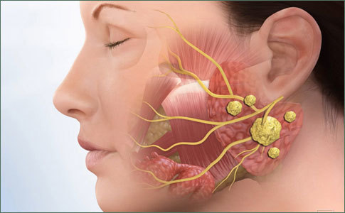 Tưởng cảm cúm hóa ra ung thư vòm họng