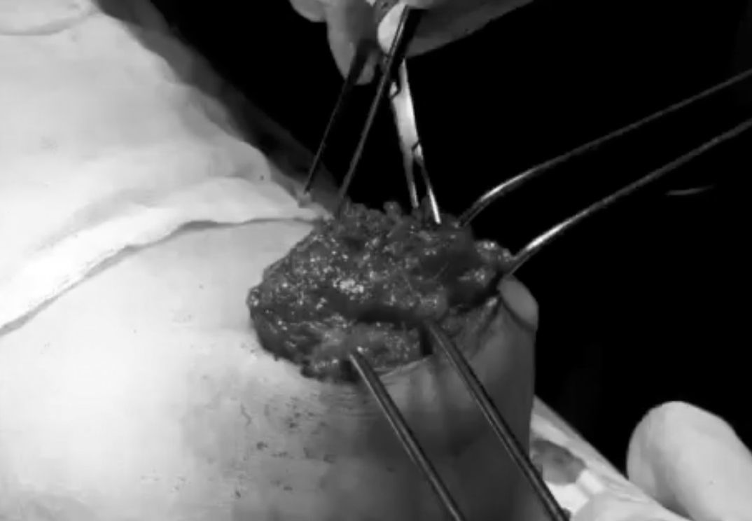 Bà nội trợ đau đớn cắt bỏ đôi gò bồng đảo do mê nâng ngực