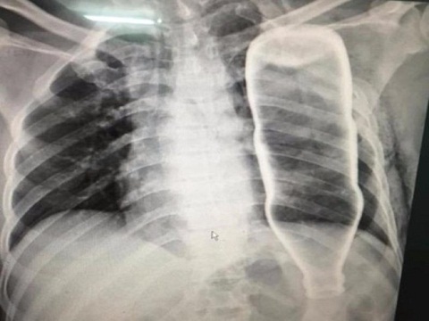 Hi hữu: Bệnh nhân bị cả chai thủy tinh chui vào lồng ngực