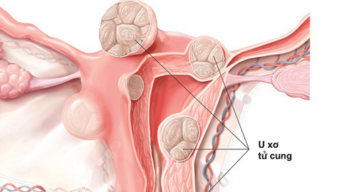 5 dấu hiệu bệnh phụ khoa nguy hiểm