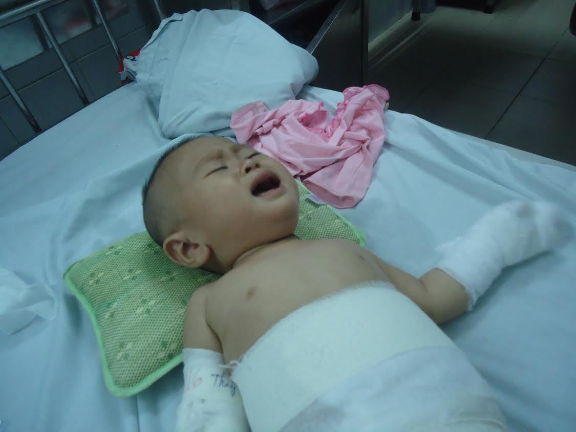 Con bỏng nặng, mẹ nghèo câm điếc khóc trong bất lực