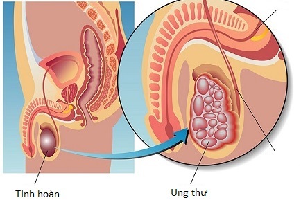 Ung thư tinh hoàn: Biết sớm, chữa nhanh