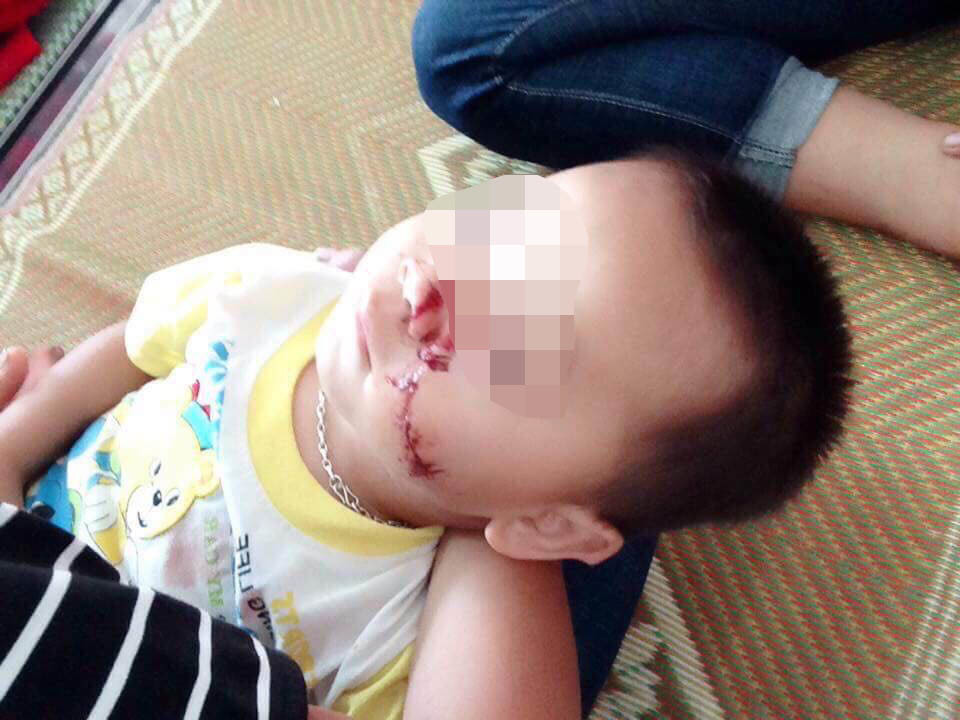 Tuyên Quang: Sự thật bé 2 tuổi bị bố chém vào mặt