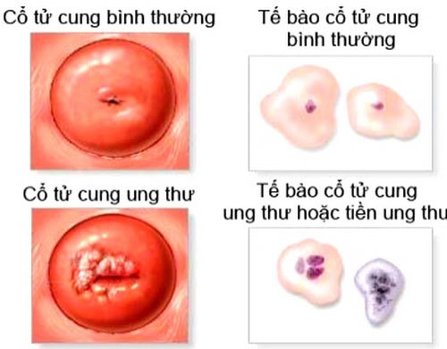 Ung thư cổ tử cung có thể sống được bao lâu?