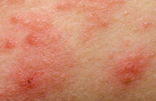 Bệnh chàm có bị lây không