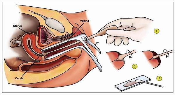 Các phương pháp điều trị ung thư cổ tử cung hiệu quả nhất