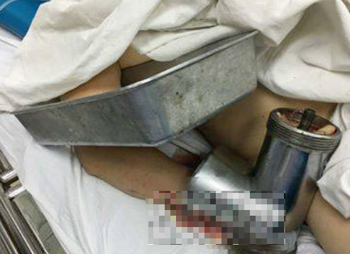 Mang cả máy xay thịt dính ở tay vào phòng cấp cứu