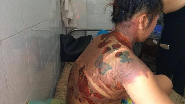 Dội nước sôi vào người vợ rồi thản nhiên bỏ đi