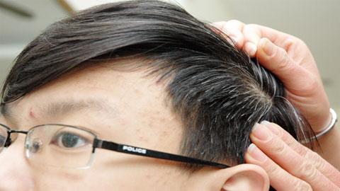 Tóc bạc sớm ở trẻ em và những lý giải từ đông, tây y kết hợp