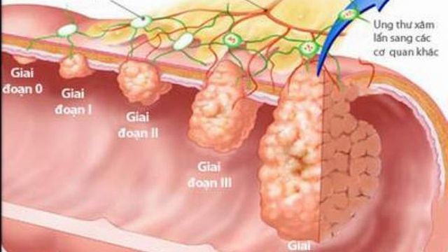 Bị ung thư dạ dày có thể sống được bao lâu?