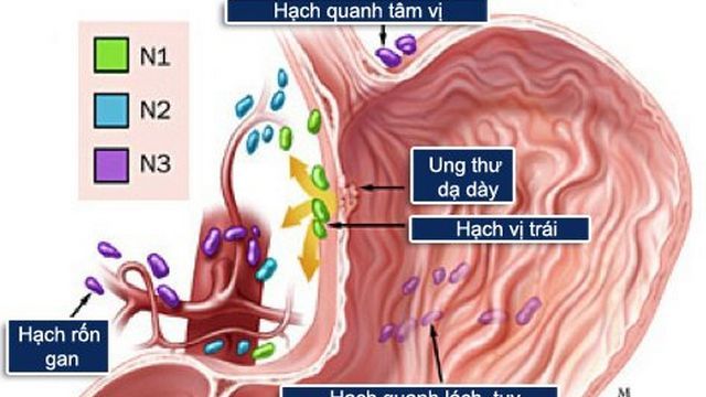 Triệu chứng ung thư dạ dày giai đoạn cuối