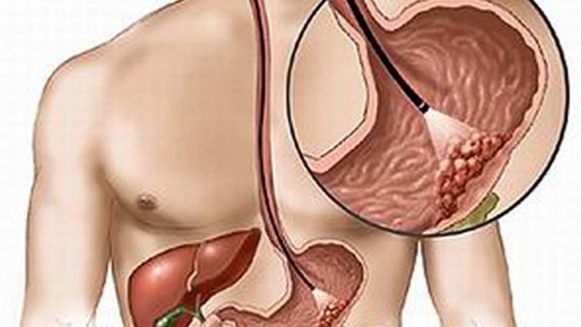 Các phương pháp điều trị ung thư dạ dày