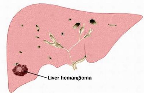 U máu trong gan có thành ung thư gan không?