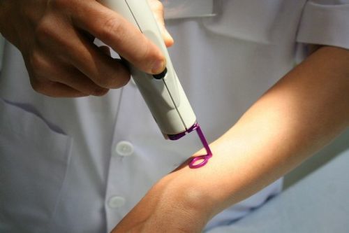 Trẻ em có nên điều trị u máu bằng tia laser