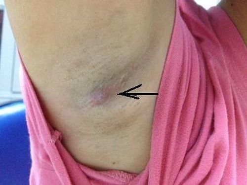 Viêm hạch ở nách có phải ung thư vú?
