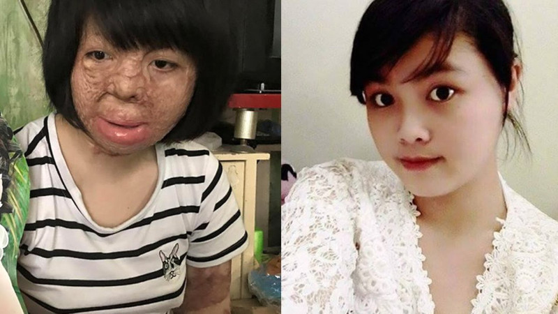Cô gái bị chồng tẩm xăng đốt và hành trình trở về từ cõi chết