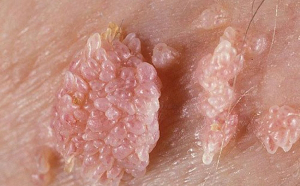 Không chỉ qua đường tình dục, bệnh sùi mào gà rất dễ lây