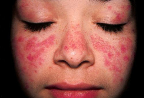 Những tổn thương do lupus ban đỏ gây ra
