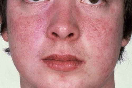 Bệnh lupus ban đỏ được hiểu như thế nào?