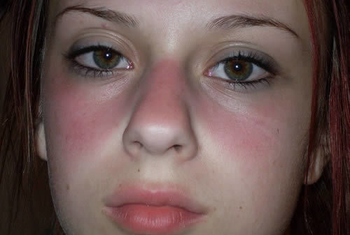 Dấu hiệu nào cho thấy bạn đã mắc bệnh lupus ban đỏ