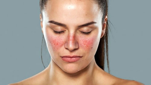 Cách phòng chống bệnh lupus ban đỏ hiệu quả