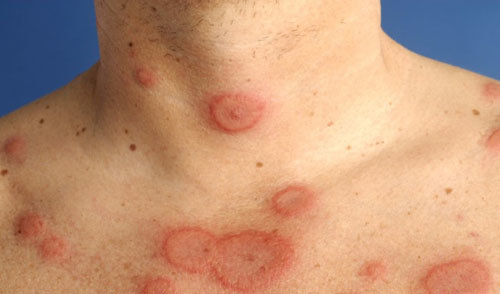 Người mắc bệnh lupus ban đỏ nên ăn gì, kiêng gì?