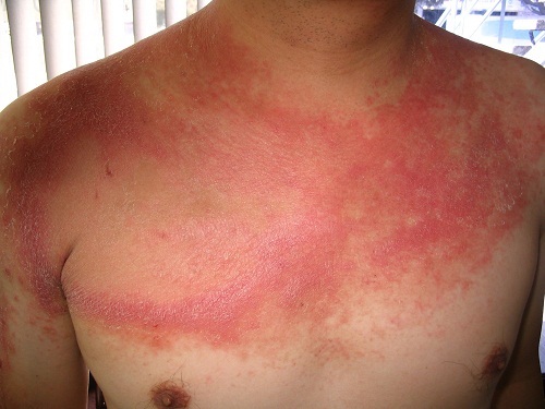 Những thắc mắc xoay quanh bệnh lupus ban đỏ