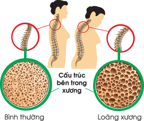 Bệnh loãng xương do những nguyên nhân nào gây nên?