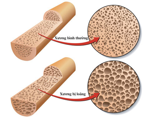 Bệnh loãng xương được hiểu như thế nào?