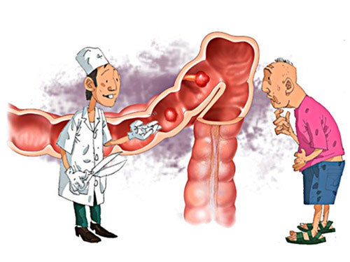 Nguyên nhân nào gây nên bệnh ung thư đại tràng