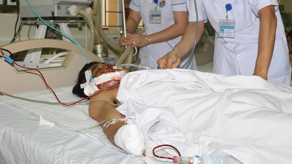 Thanh niên nát mặt, tàn phế 2 tay vì nổ mìn đánh cá