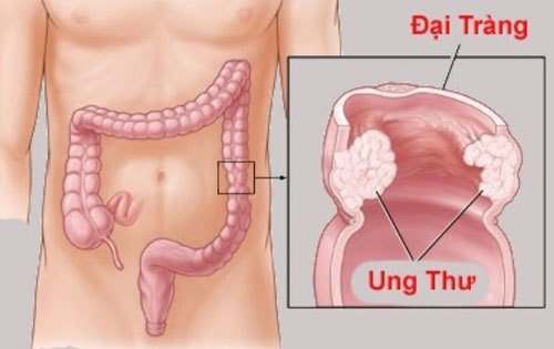 Những lời khuyên hữu ích trong việc phòng tránh ung thư đại tràng